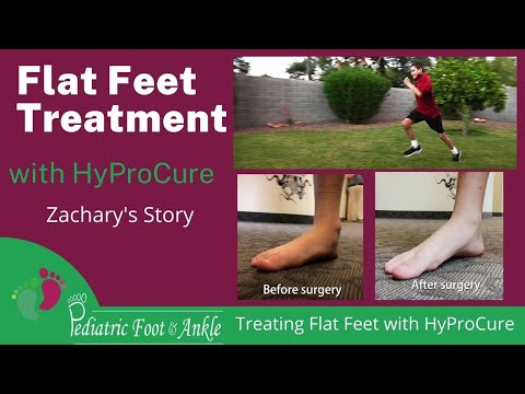 Flat Feet Correction with HyProCure Surgery Zachary's Story