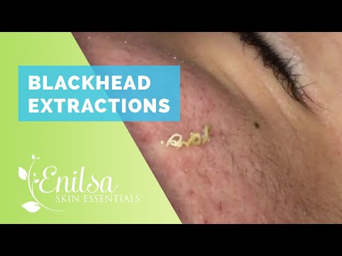 Blackhead Extractions on “K” #9