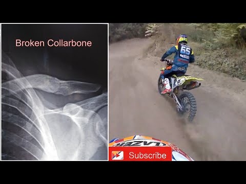 Motocross Race Crash and broken collarbone