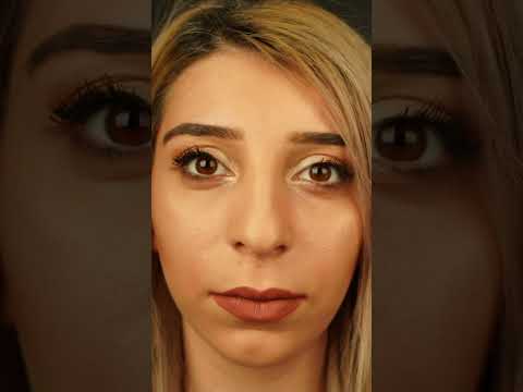 Postop 1,5 year rhinoplasty -  Dr Guncel Ozturk