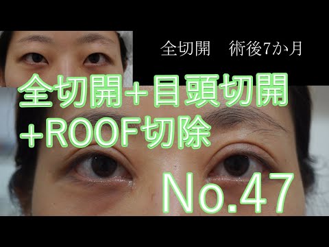 切開二重+目頭切開+ROOF切除　47