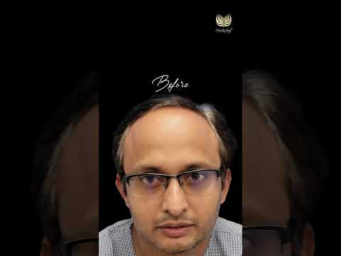 Incredible Hair Transplant Outcome! | MedLinks #shorts #shortsfeed