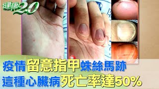 疫情期間留意"指甲"蛛絲馬跡 這種"心臟病"死亡率達"50%" 健康2.0