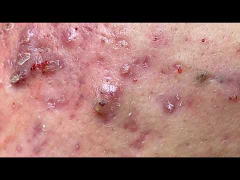 Acne Removal from Cheeks and Nose, Milia, Skill Acne Remove, Pimple Popper Videos 2019