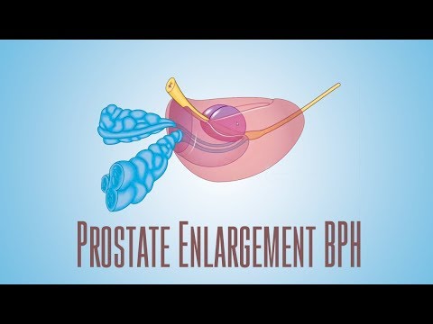 Prostate Enlargement BPH