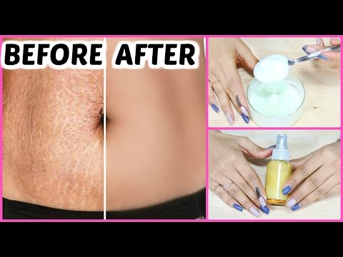 DIY STRETCH MARKS Removal Cream - Guaranteed Results In 6 Weeks | PrettyPriyaTV