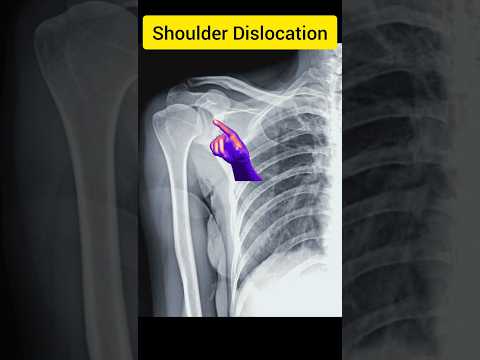 Shoulder Dislocation