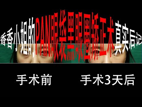 香香小姐的黑眼圈矯正日記2. PAN眼袋黑眼圈矯正術后第3天