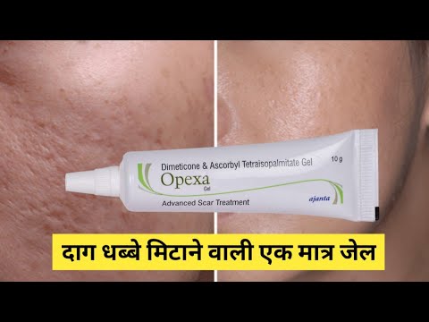 त्त्वचा पर से दाग धब्बे मिटाने वाली 1 मात्र असरदार जेल - Opexa Gel Advanced Scar Treatment (Review)