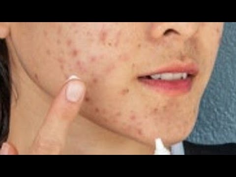 5 Must-Try Spot Treatments | How to Make Acne Disappear Fast | Fast-Acting Acne Solutions สิวยุบเร็ว