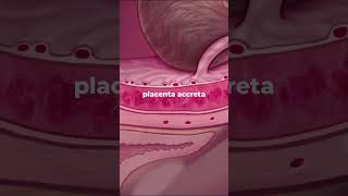 What is Placenta Accreta Spectrum? Placenta abnormalities #pregnancy #placenta