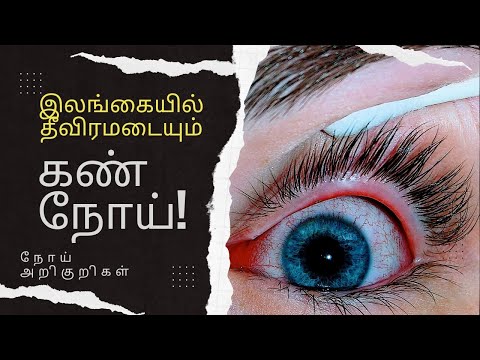 இலங்கையில் தீவிரமடையும் கண் நோய் | Eye disease in Sri Lanka | Eye infection symptoms in tamil