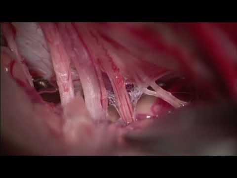 Microsurgical resection of an enlarging lateral pontomedullary cavernous malformation