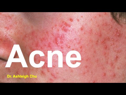 Acne by Dr. Ashleigh Chu