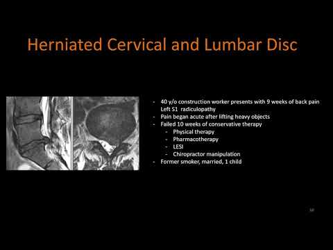 AANS Coding Shorts: Basic Lumbar Spinal Coding Bits