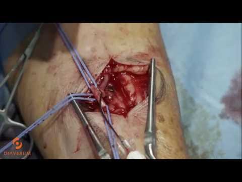 Vascular access - Your lifeline