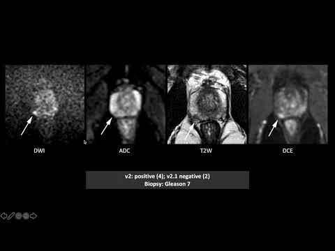 PI-RADS v2 and v2.1: Interobserver Agreement and Diagnostic Performance in PZ and TZ lesions