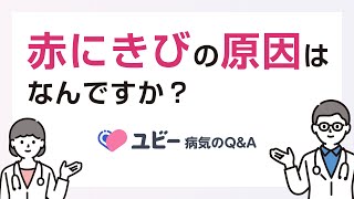 赤にきびの原因はなんですか？【ユビー病気のQ&A】