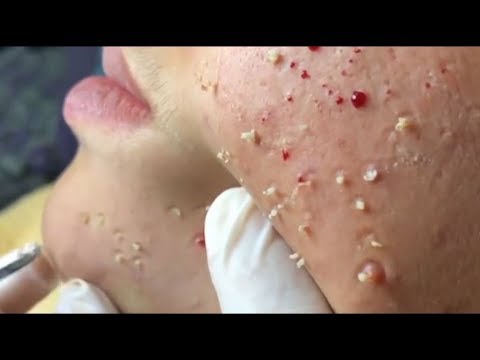 Deep Whiteheads Removal, How To Rid Of Pimples, Milia