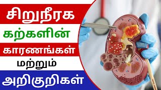 சிறுநீரக கற்களின் காரணங்கள் மற்றும் அறிகுறிகள் | Causes and Symptoms of Kidney Stone in Tamil