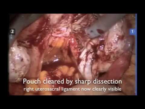 Robotic Endometriosis cystectomy Dr Rooma SInha Apollo Hospital Hyderabad   YouTube 360p