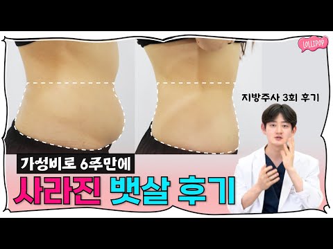 뱃살, 허벅지, 부유방 부위는 이렇게 빼세요! (+지방주사 받은 원장님 바디프로필 후기 공개)