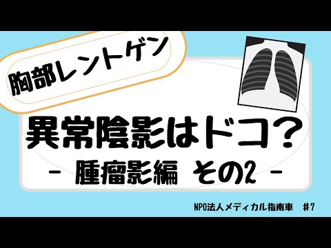 胸部レントゲンで見える異常陰影はドコ？　腫瘤影編 その2