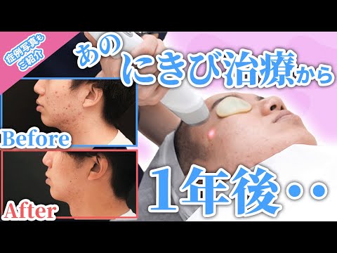 【ニキビ治療】患者様密着part.2☆カウンセリング～治療までの施術内容を大公開☆【ニキビ跡・サリチル酸ピーリング・コメド・ジェネシス・エクセルV・LEDライト】