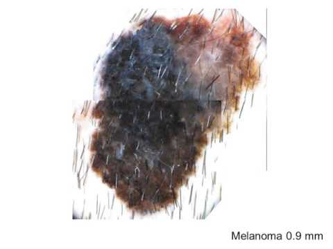 Melanoma diagnosis by Dr. A. Scope 1/2