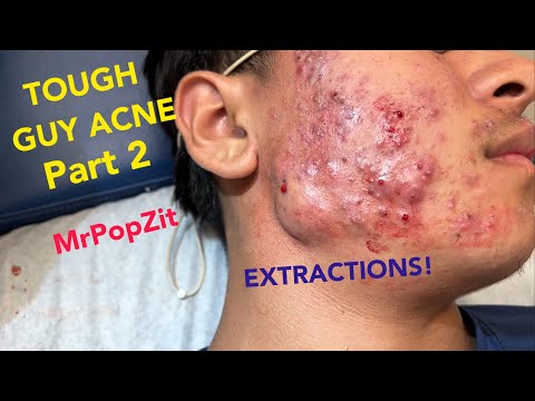 Very severe acne in a preteen patient.Follow his progress.Extractions of blackheads and whiteheads.