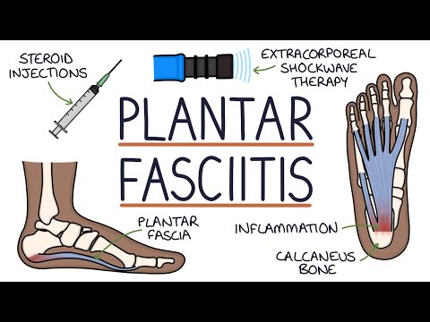 Understanding Plantar Fasciitis