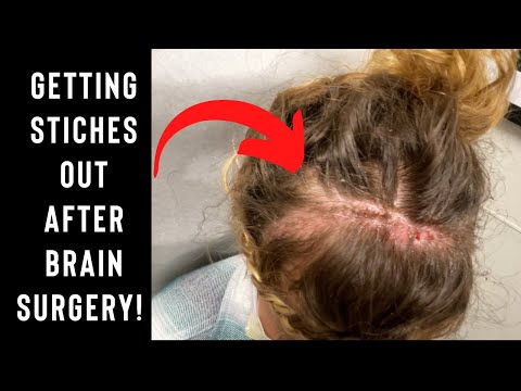 2 Weeks Post Brain Surgery | Head Stitches Finally Coming Out!