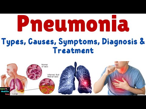 Pneumonia: Causes, Symptoms, Diagnosis, Treatment & Prevention