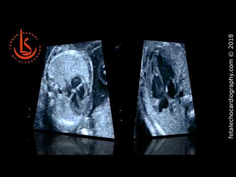 Ventricular septal defect (VSD): fetal echocardiography