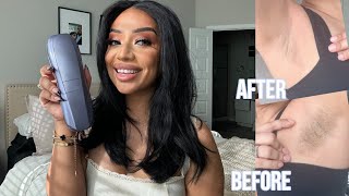 Testing out the VIRAL Ulike IPL Hair Removal System | My before and after!