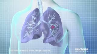 Screening for Lung Cancer