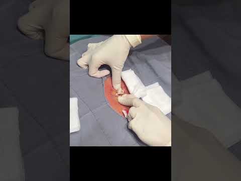 TWO SUPER CYSTS