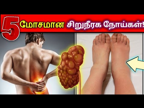 05 மோசமான சிறுநீரக நோய்கள்! | 05 Dangerous Kidney diseases in tamil | கண்டிப்பாக அறிந்துகொள்ளுங்க!