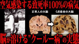 空気感染する致死率 100%の病気”プリオン病”をご存知ですか？