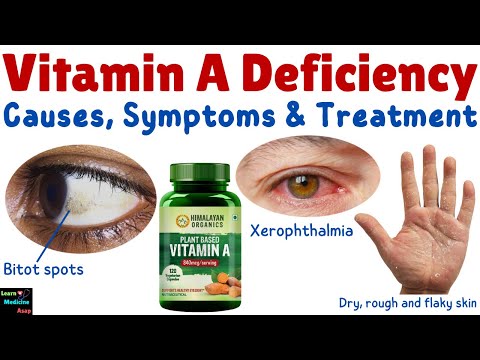 Vitamin A Deficiency – Causes, Symptoms, Diagnosis, Treatment & Prevention