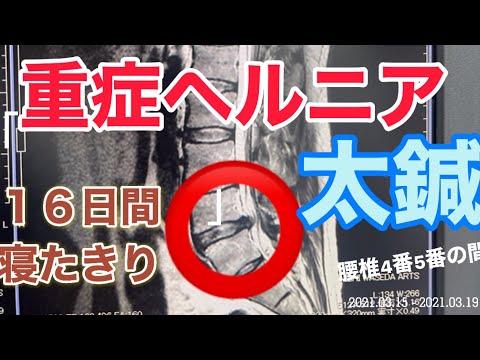 熟女式YouTuber重症ヘルニア治療【鍼】坐骨神経痛