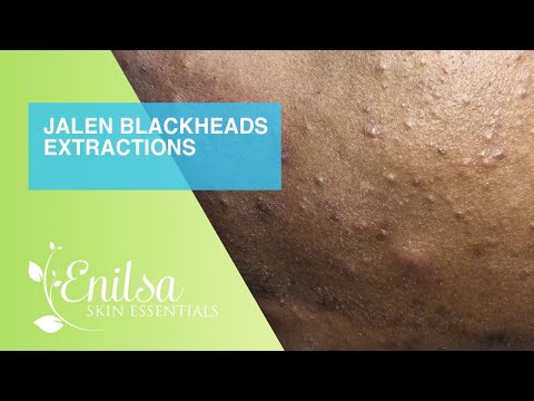 Jalen’s Blackheads Extractions (Nice and Clean)