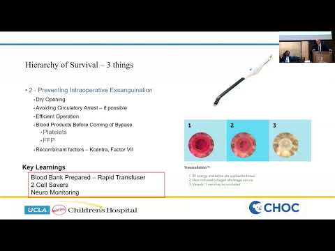 OHT vs CHLT  The Cardiac Surgeon's Perspective - Glen Van Arsdell, MD