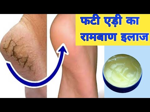 अपनाएं इस घरेलु नुस्खे को और फटी एडियों से हमेशा के लिए छुटकारा पायें /Cracked Heels ...