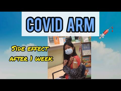 COVID ARM | Side Effect After 1 Week | Moderna Vaccine