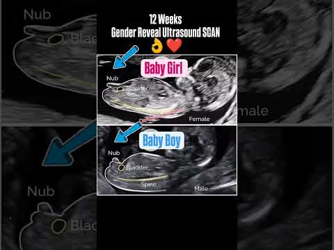 12 Week's Gender Reveal Ultrasound Scan #genderpredictions #genderdetermination #genderreveal