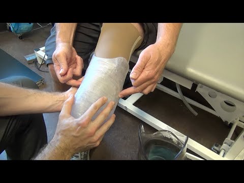 Using 3D printers to help build prosthetic sockets