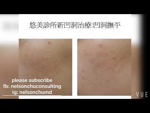 痘疤治療實例 Acne scar treatment