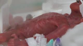 超低出生体重児。息子。NICU。生後４日目。368g。Premature baby