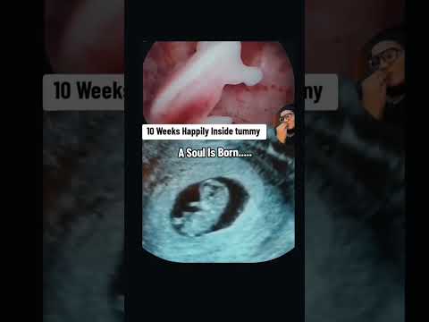 10 Weeks happily playing inside Womb #10weeks #10weekspregnant #baby #pregnancyscan